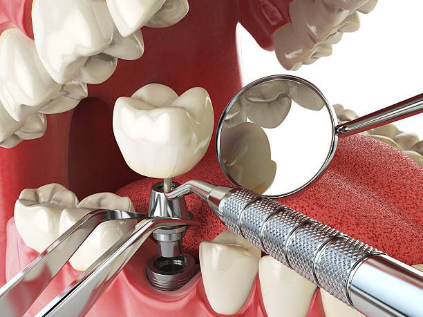 Best Broken or Cracked Tooth Emergency Dentist in Kyle, TX